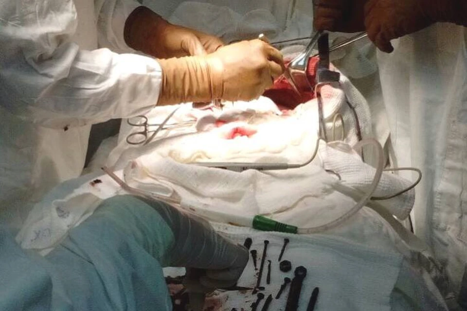 Хирурги удалили 150 гвоздей, шурупов и болтов из желудка жительницы Бурятии. ФОТО: предоставлено Республиканской клинической больницы имени Н.А.Семашко.