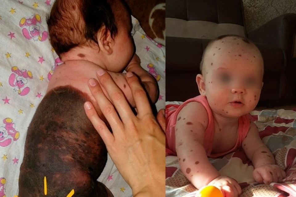 Девочка с гигантским невусом на пол тела, поступила в клинику Петербурга для лечения