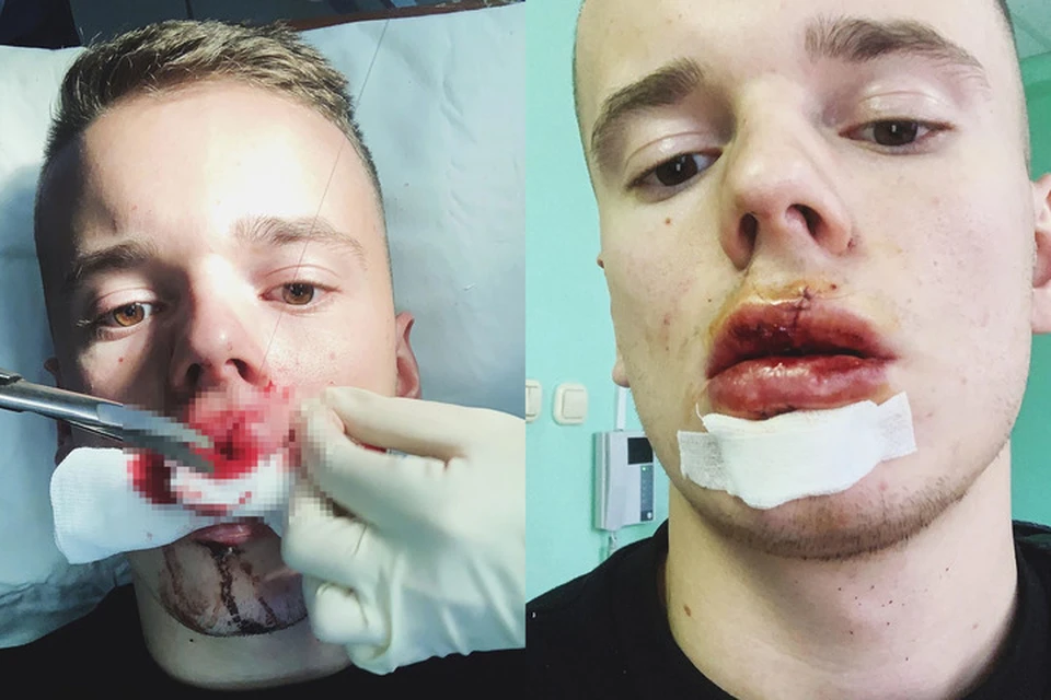 Юношу уже впустили из больницы, но проблемы на этом не заканчиваются - по словам Арсения, ему, возможно, придется удалять передние зубы. Фото: Instagram
