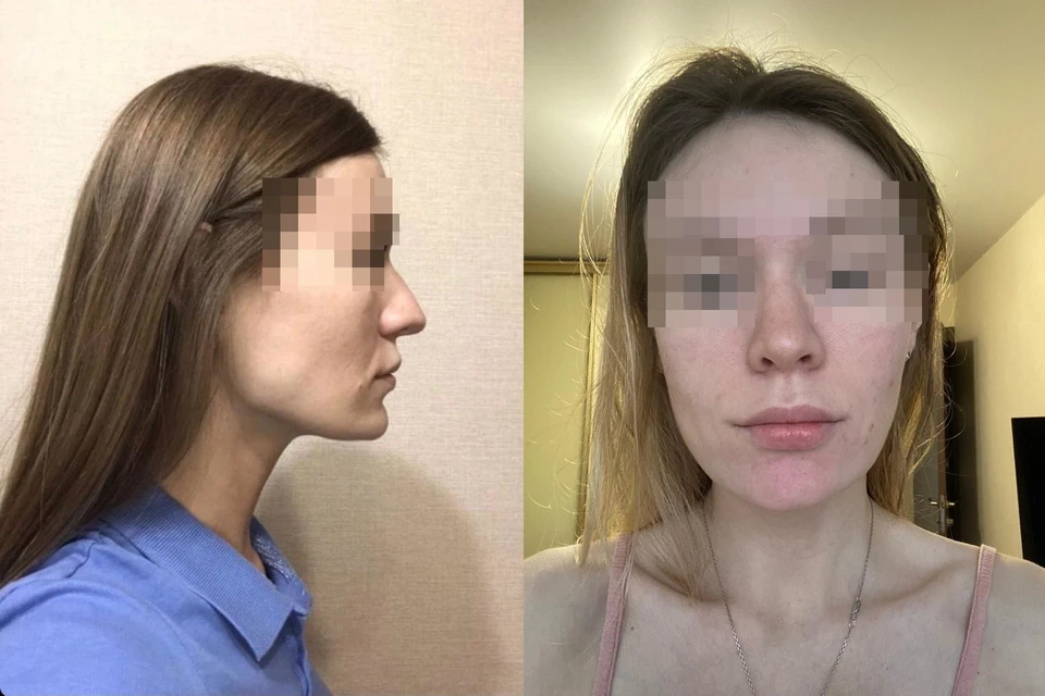 Маша до операции (на фото слева) и после (на фото справа). Фото: личный архив.