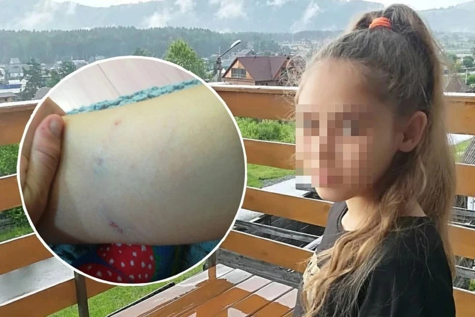 Бродячая собака вцепилась девочке в ногу. Фото: предоставлено героями публикации КП-Новосибирск