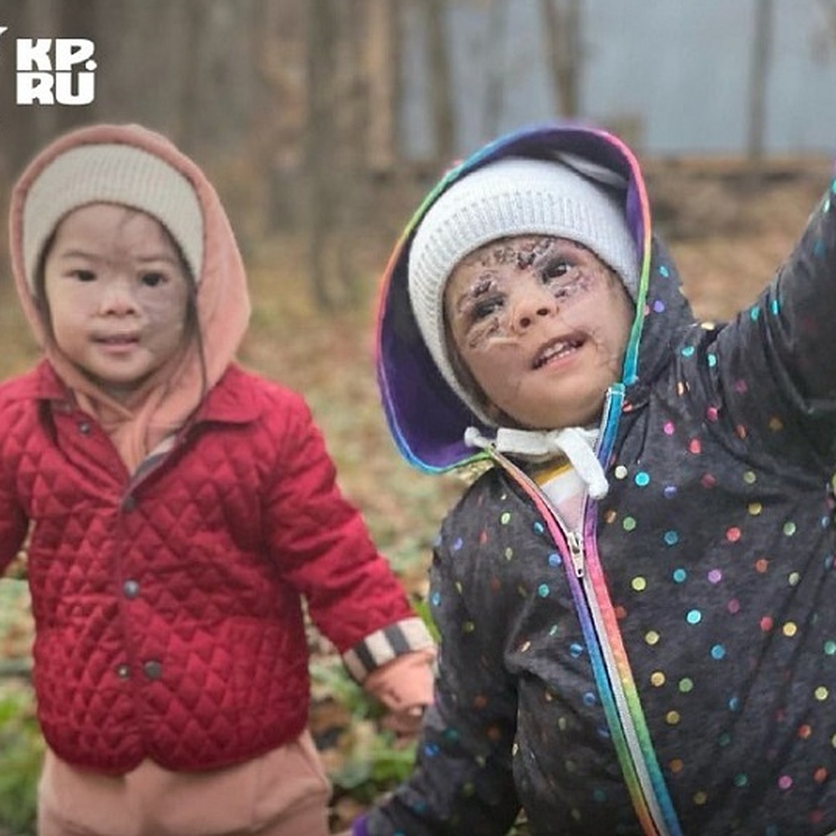 Родимое пятно победили»: девочку с «маской Бэтмена» готовят к курсу  подкожных инъекций в России - KP.RU