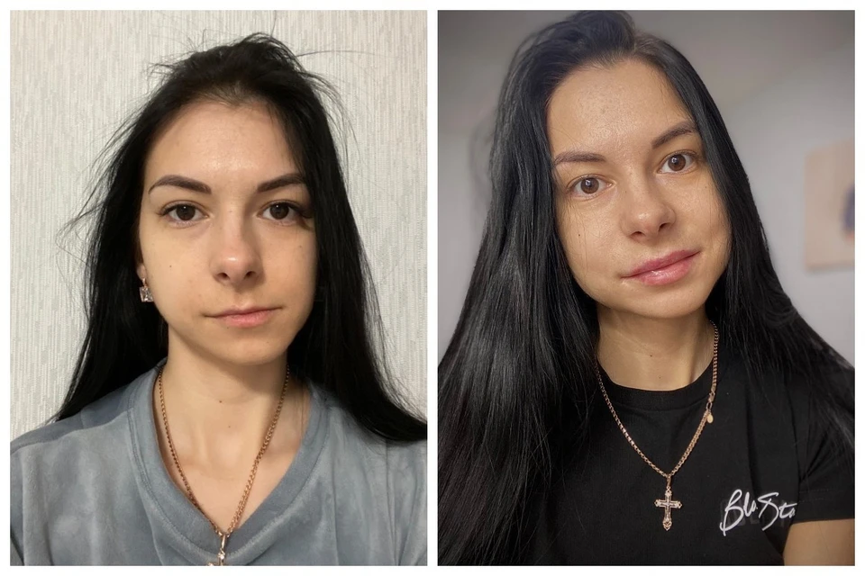 Татьяна Файзуллина до операции (слева) и после (справа)