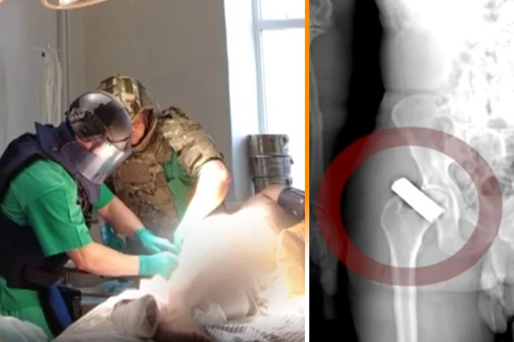 Медицинская операция в касках и бронежилетах: как хирурги и пиротехники извлекли из раненного бойца неразорвавшуюся гранату