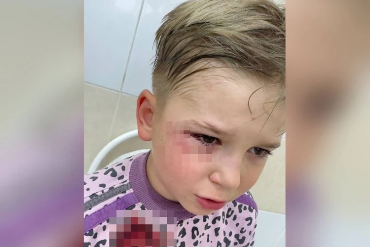 Еще два миллиметра - и лишился бы глаза. Бродячая собака укусила 7-летнего мальчика за лицо