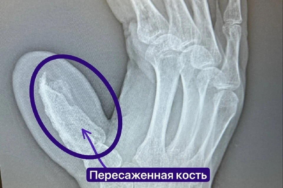 Для полного восстановления понадобилось несколько операций. Фото: t.me/rkb_tatarstan