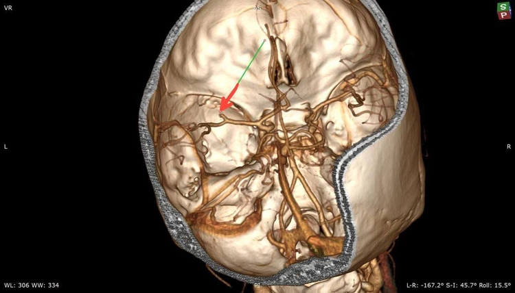Воронежские врачи спасли 35-летнюю женщину с инсультом