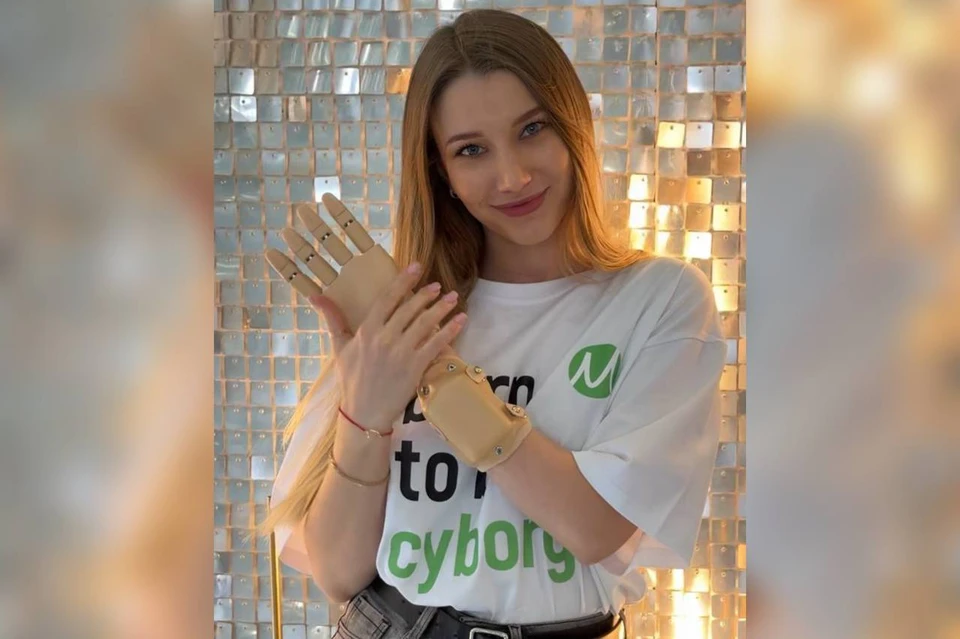 Девушка родилась с врождённой аномалией – аплазией левой кисти руки