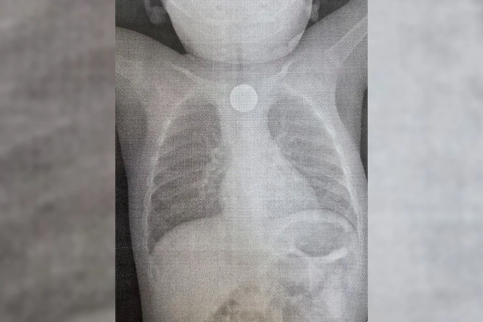 годовалый мальчик проглотил сразу два опасных предмета. Фото: ДРКБ.