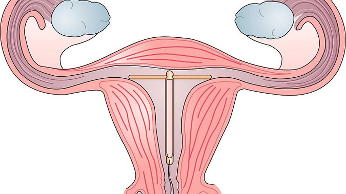 Внутриматочная спираль - KP.RU