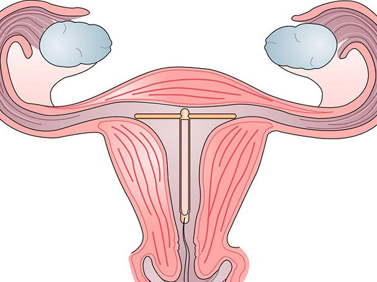 Внутриматочная спираль - KP.RU