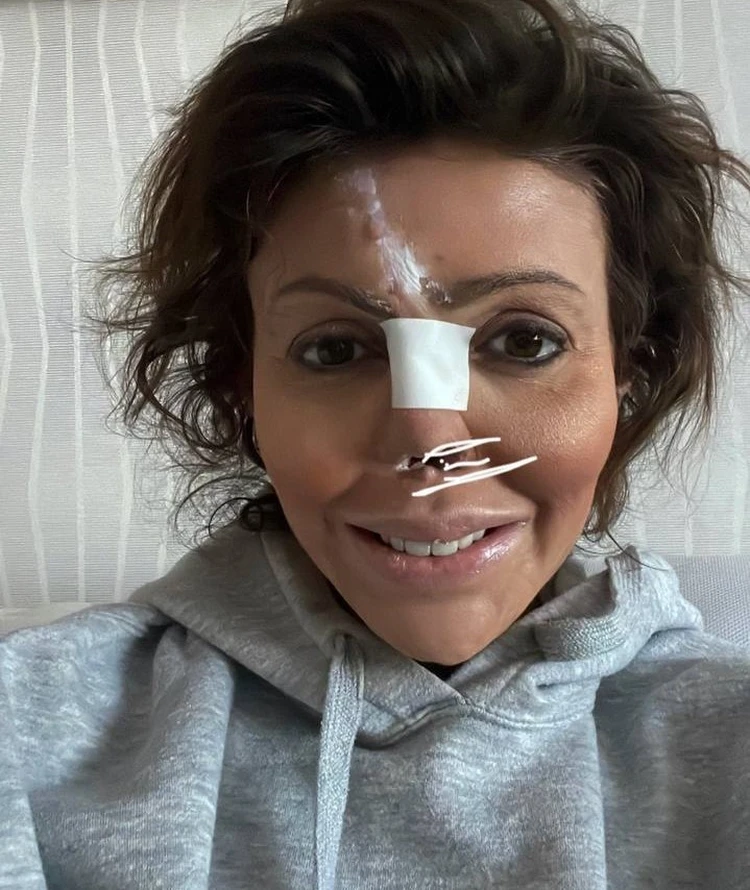 Женщина пыталась восстановить нос с помощью пластического хирурга ФОТО: соцсети