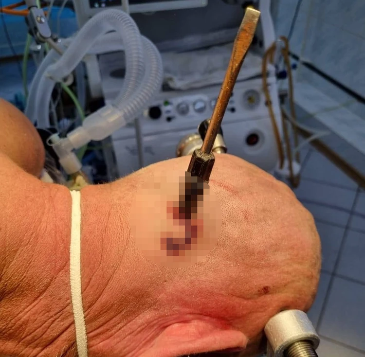 В Башкирии врачи спасли мужчину, которому  голову воткнули отвертку